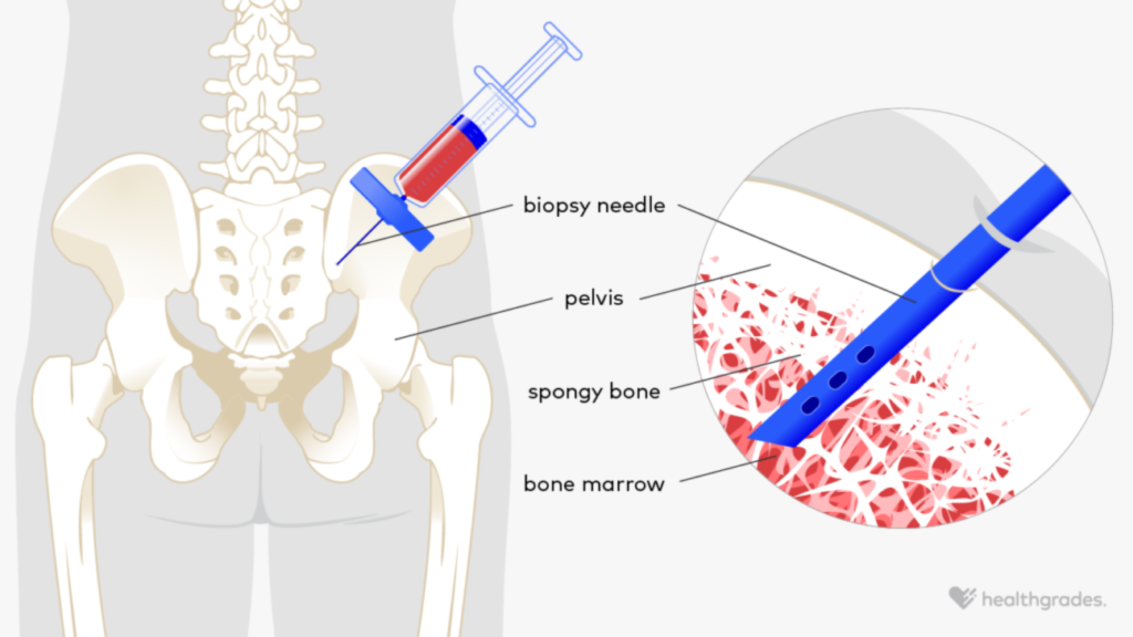 Aspirado de medula óssea
