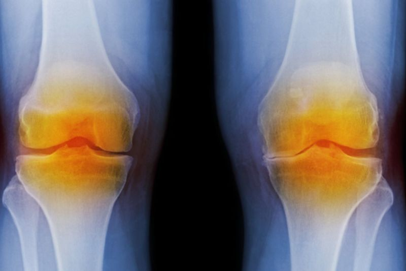Osteoartrite joelho